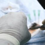 How Turkey Hacked Hair Transplant