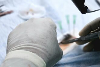 How Turkey Hacked Hair Transplant