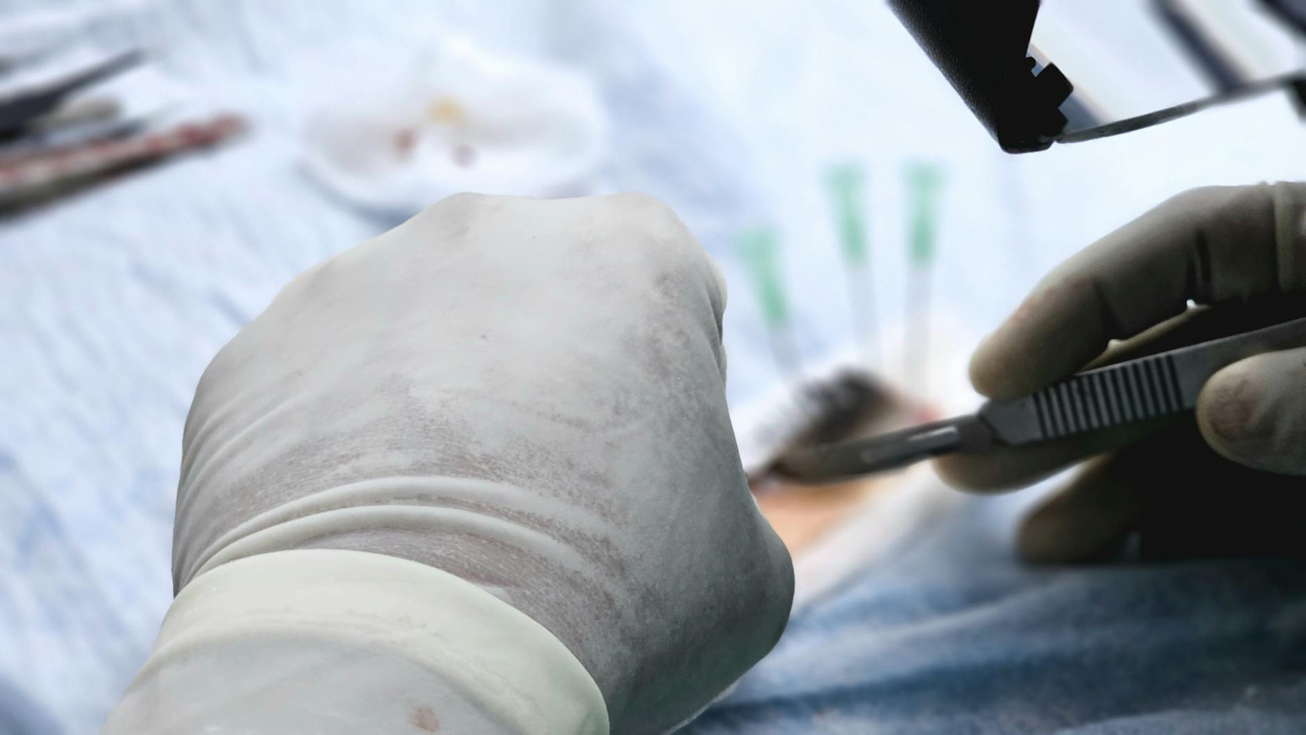 How Turkey Hacked Hair Transplant